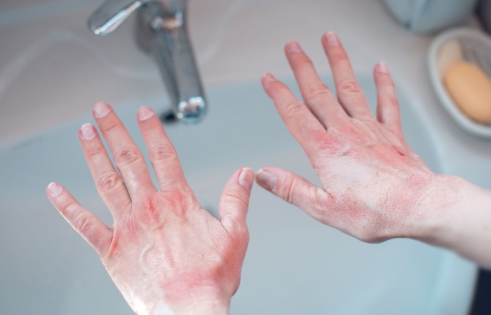 Zealous Handwashing Can Lead to Redness and Irritation