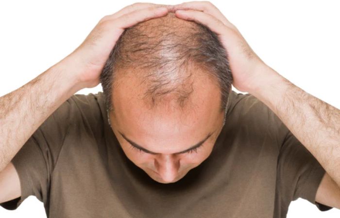 Hereditary Hair Loss