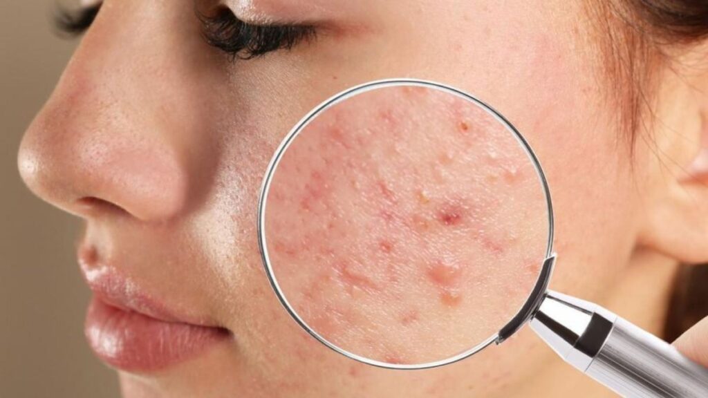 Can acne be treated naturally? Advice from the experts